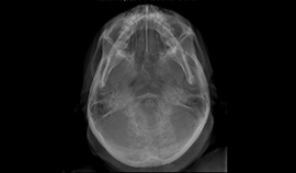 Radiografia Axial (HIRTZ)