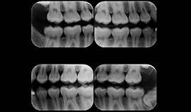 Radiografia interproximal