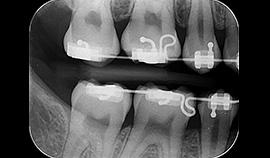 Radiografia Periapical Convecional e Digital