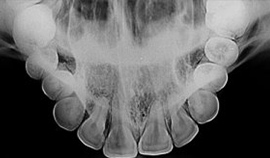 Radiografia oclusal