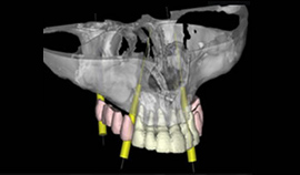 Dentalslice (BIOPARTS®)