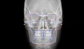 Analises Cefalométricas