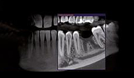 Tomografia Computadorizada Cone-Beam dos Maxilares / Trauma / Patologias